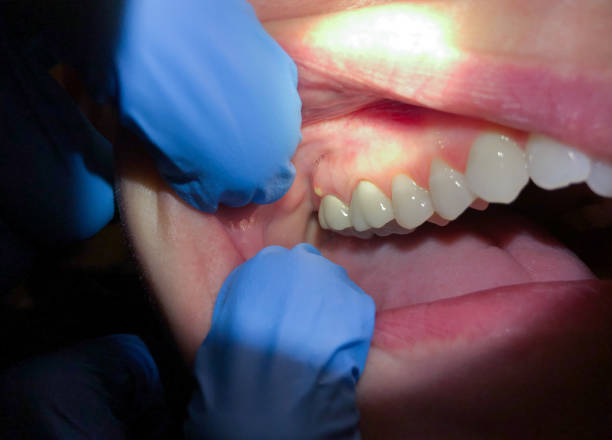 Best Broken or Cracked Tooth Emergency Dentist in Birngham, MI
